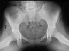 Posicionamiento Axial de Cadera